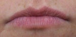 BEFORE JUVEDERM
